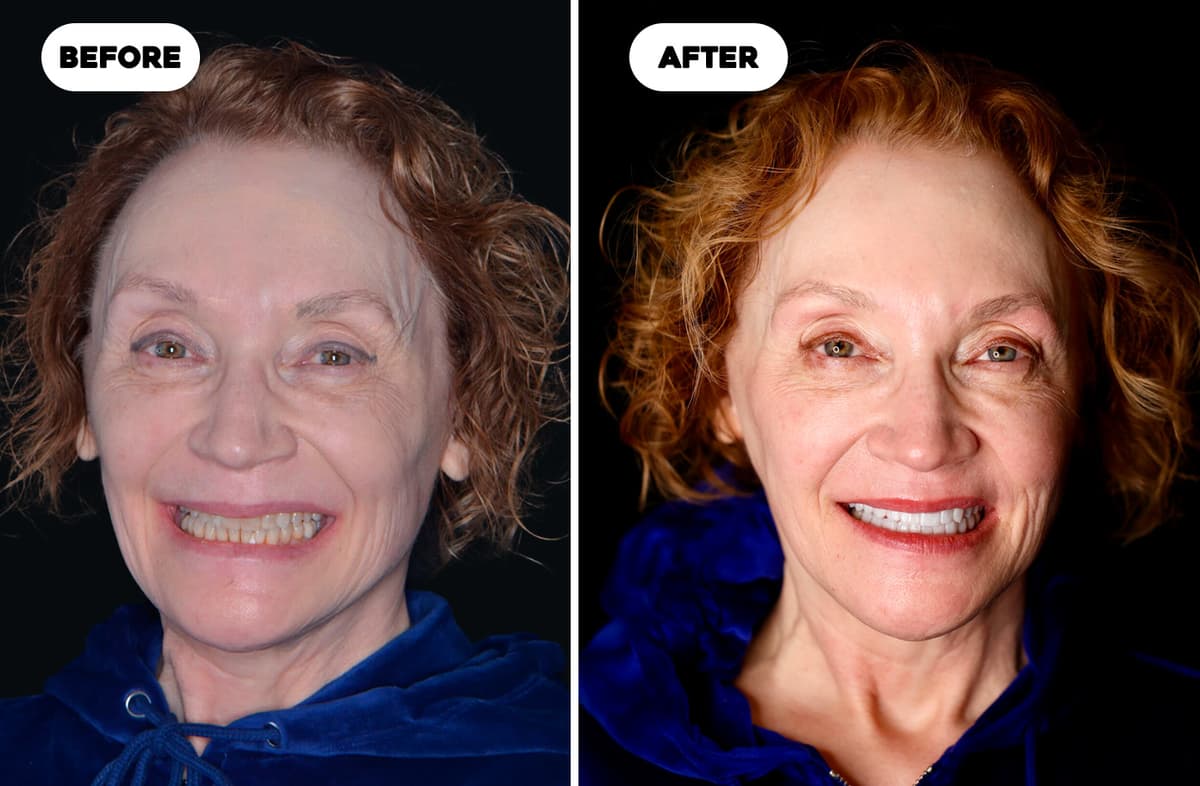 Teeth Whitening
