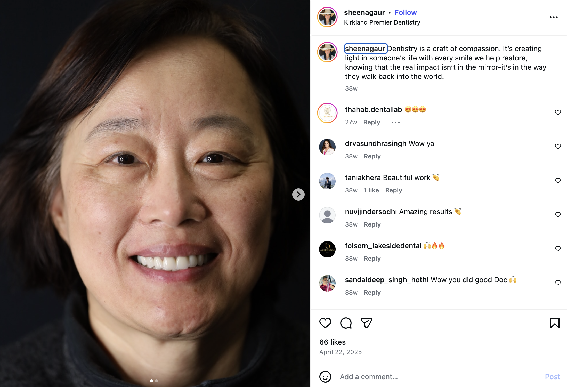 Instagram-style veneer transformation post shared by Kirkland Premier Dentistry