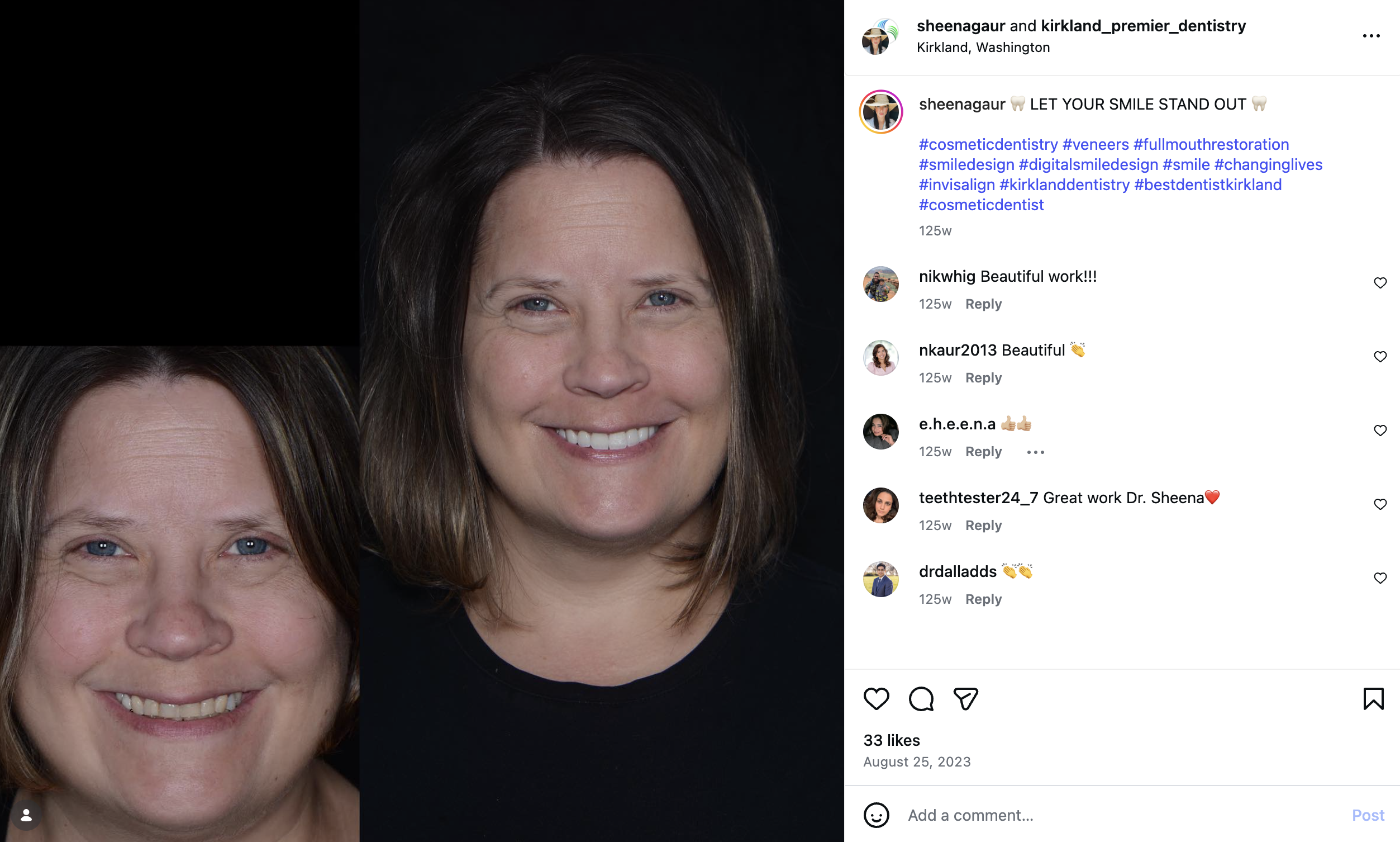 Instagram-style post featuring a veneer before and after shared by Kirkland Premier Dentistry